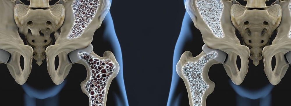 everything you need to know about osteoporosis