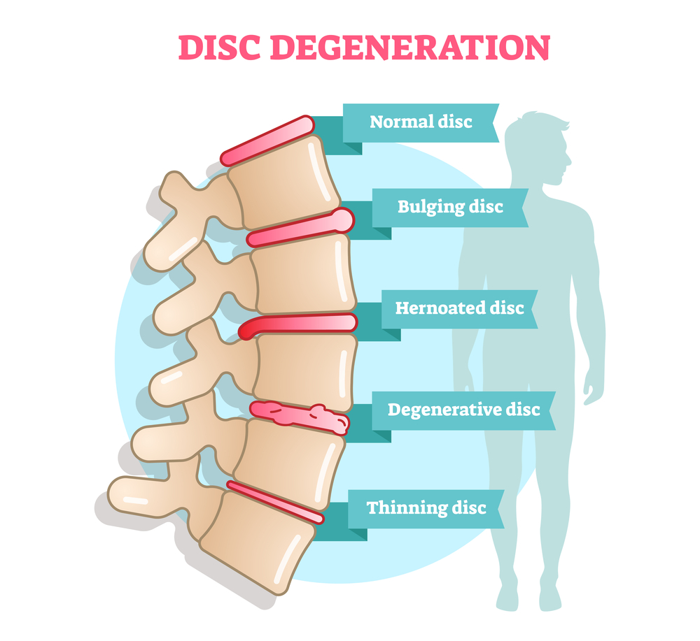 spinal degeneration causes spinal instability