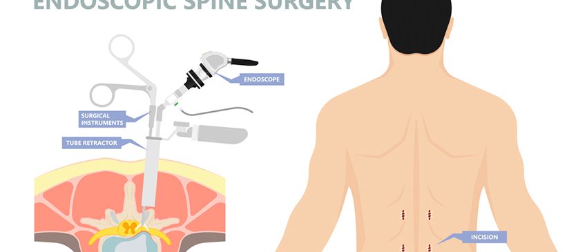 Recovery After Endoscopic Spine Surgery