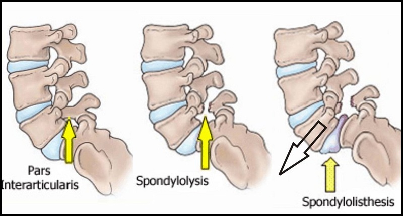 traumatic spondylolisthesis symptoms