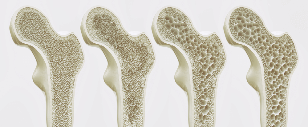 thinning of cortical bone and reduced density of spongy bone